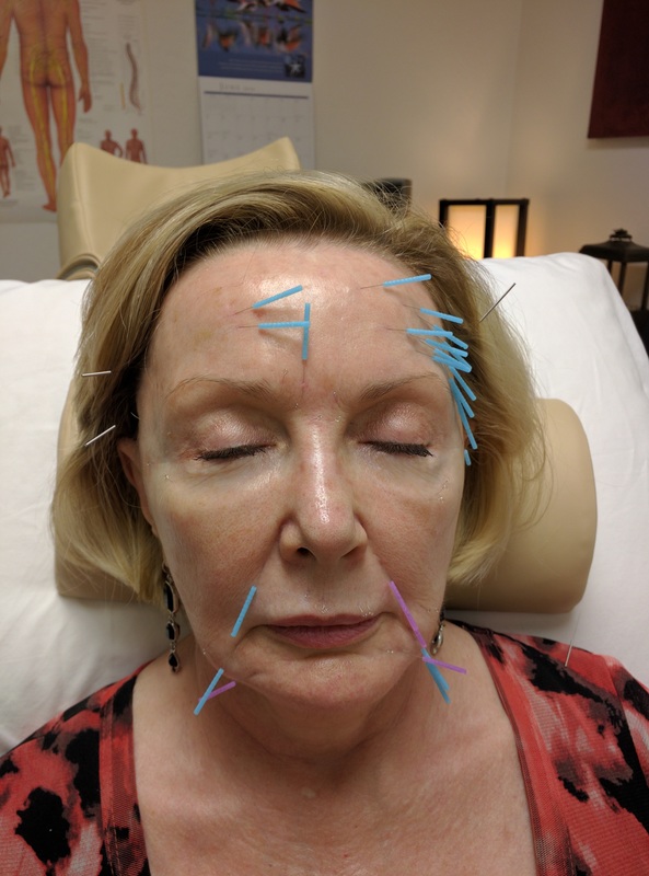 Acupuncture Facial Rejuvenation in Scottsdale  - During Treatment